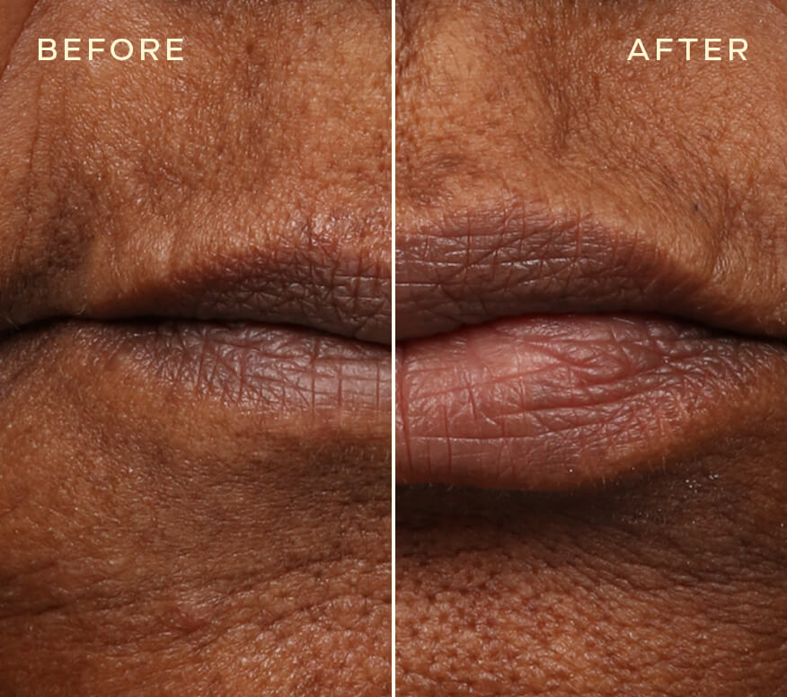 Repleneshing Lip Filler