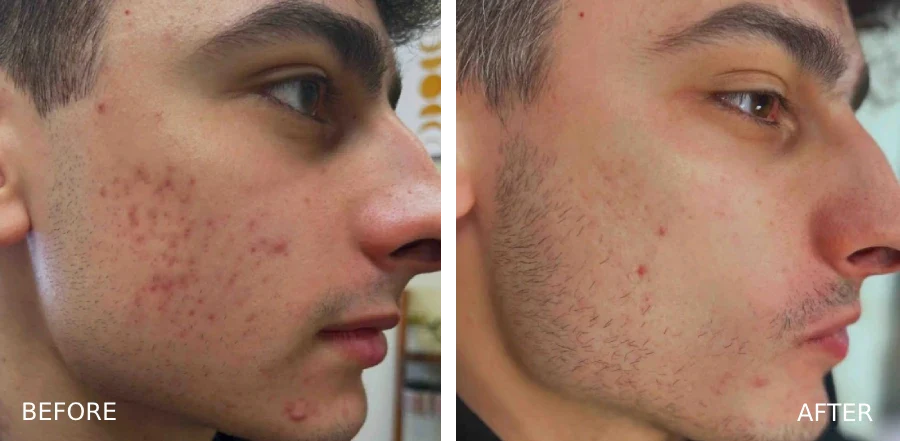 Microchanneling on Active Acne: Busting the Myths