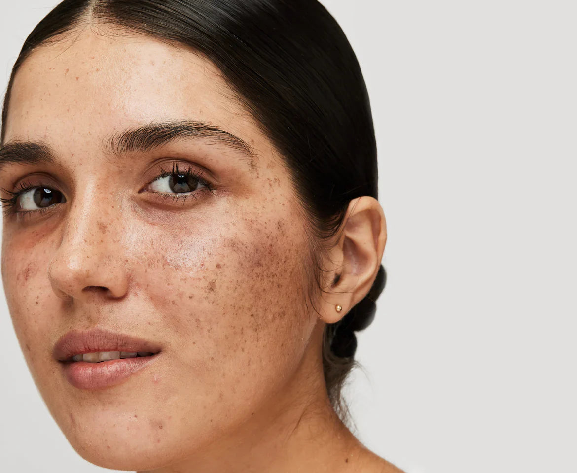 Ingredients That Help Treat Melasma