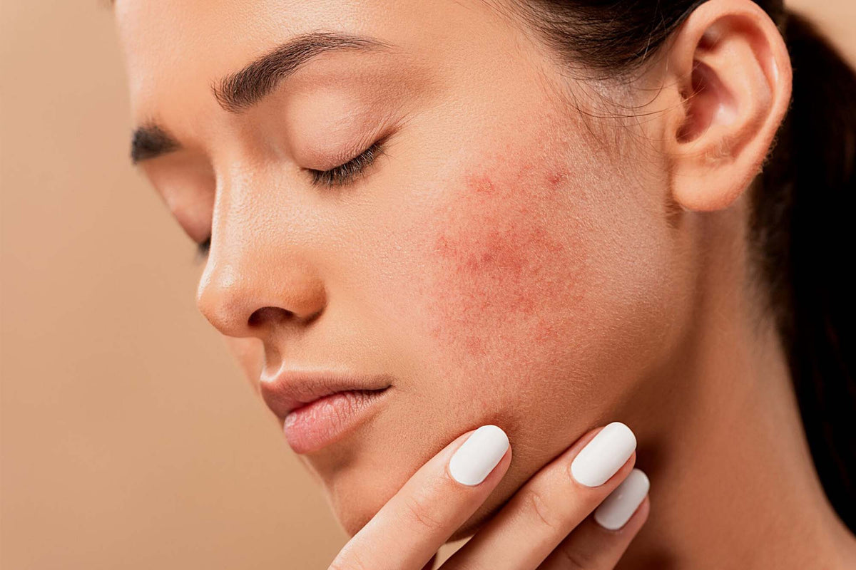 Top Ingredients That Actually Work for Acne