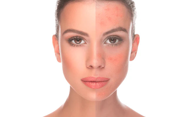 What Triggers Rosacea? Understanding What Your Skin Is Reacting To