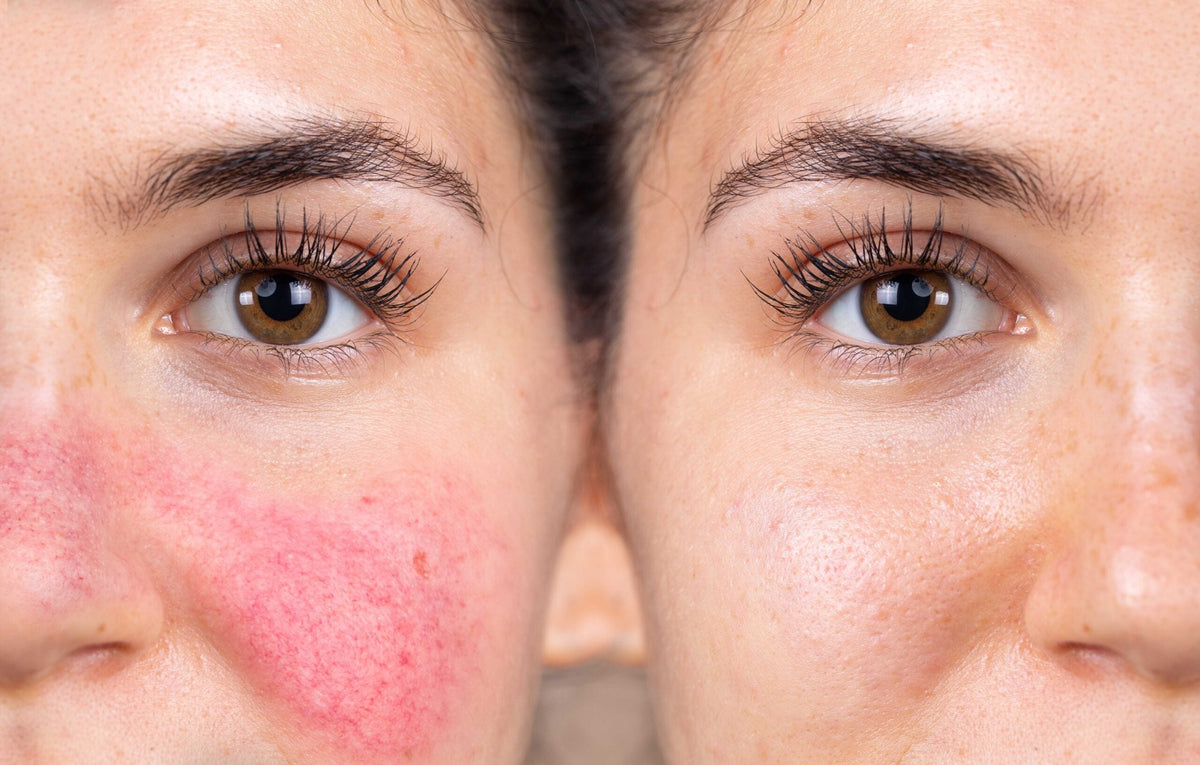 Rosacea Friendly Ingredients That Actually Soothe Your Skin