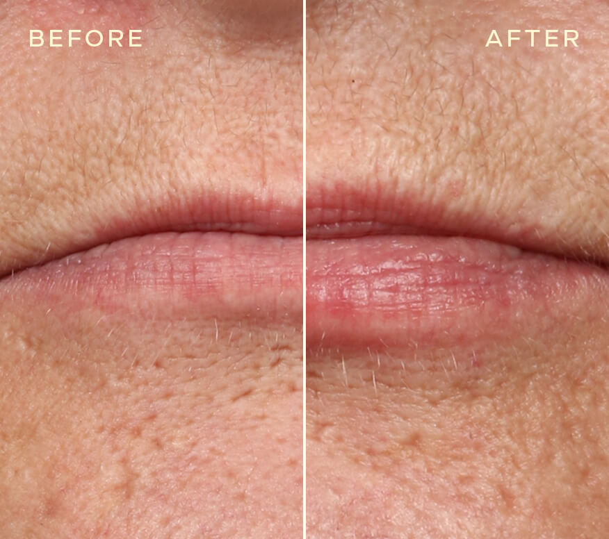 Repleneshing Lip Filler
